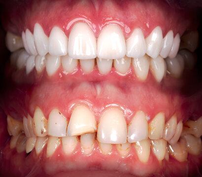 Perfect smile before and after veneers bleach of zircon arch ceramic prothesis Implants crowns. Dental restoration treatment clinic patient. Result of oral surgery procedure whitening dentistry