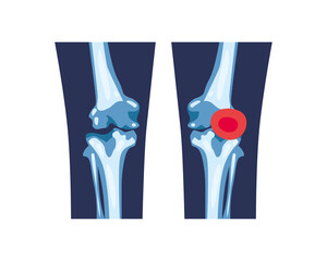 Rheumatology legs bones