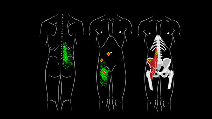 Trigger points and reflected pain in psoas major muscle, psoas minor muscle and in Iliacus muscle.