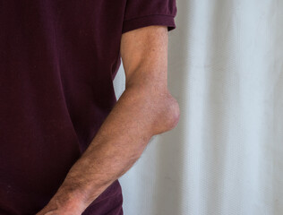 Man with elbow bursitis
