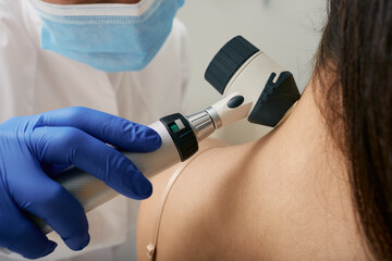 Mole dermatoscopy. Doctor examines the patient's mole with a dermatoscope for prevention of...