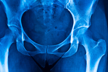 Hips pelvis xray scan