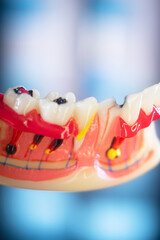 Tooth decay dental model