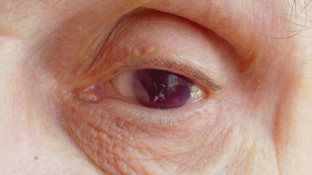 Eye with complete loss of vision, close-up.