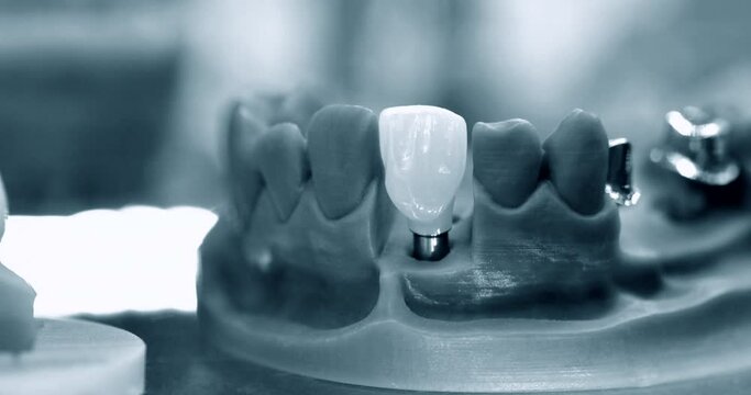 Collapsible jaw model wih teeth and holes for implant crown