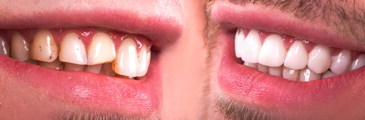 Perfect smile before and after veneers bleach of zircon arch ceramic prothesis Implants crowns. Dental restoration treatment clinic patient . Result of oral surgery procedure whitening dentistry