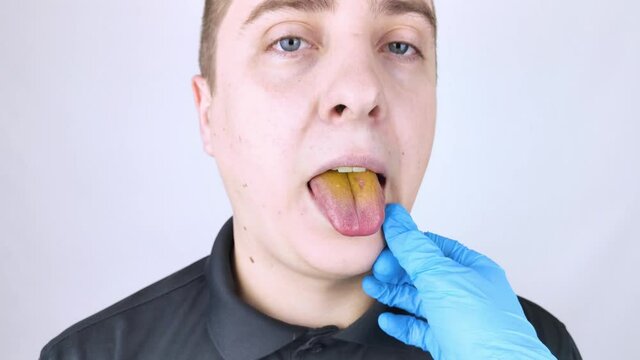 The man has a yellow tongue. Painful yellow coating on the mucous membrane of the tongue. Diseases of the gastrointestinal tract, liver and gallbladder. The consequences of taking antibiotics.