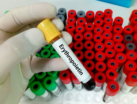 Blood sample for Erythropoietin (EPO) test, stimulating hormone for RBC production
