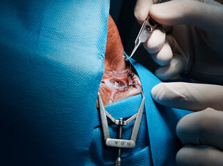 basra, Iraq - april 8, 2021:  surgeon putting contact lets on the cornea post PRK operation