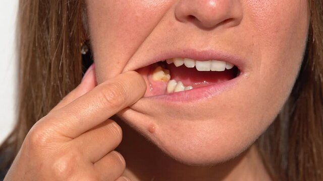 Sad woman showing her mouth without tooth on lower jaw. Missing tooth or no tooth. Woman after tooth extraction