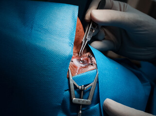 basra, Iraq - april 8, 2021:  surgeon putting contact lets on the cornea post PRK operation
