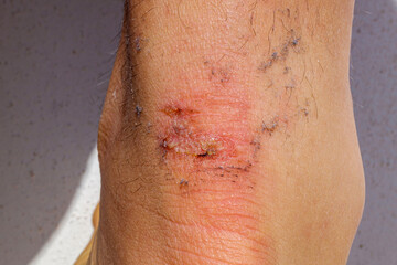 Detail of the wound produced by a burst blister on the achilles of an athlete.