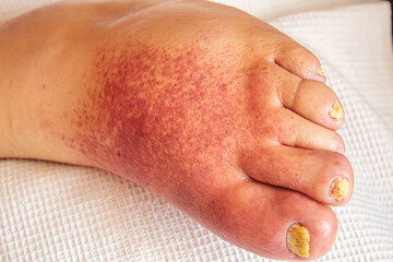 erysipelas of the legs, red rash on the legs.selective focus