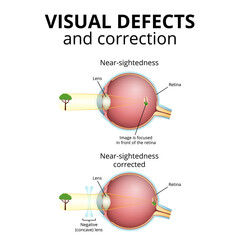 structure of the eyeball, visual impairment, near-sightedness