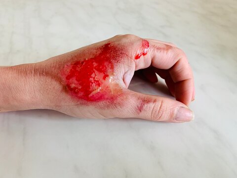 Close-up of a wound with blood on the arm after a burn. Injury. Wound.