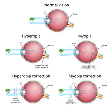 vision problems and their correction, myopia and hyperopia