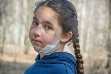 In the spring, in the forest, the girl's face is covered with scratches and bruises after a dog bite.