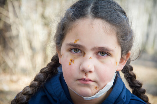 In the spring, in the forest, the girl's face is covered with scratches and bruises after a dog bite.