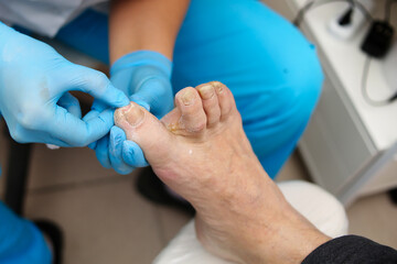 Treatment of an ingrown toenail for a man. Relief of pain. Podology treatment. Podiatrist treating...