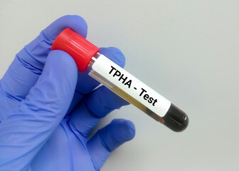 Fototapeta premium Blood sample for Treponema pallidum haemagglutination (TPHA) test, Syphilis disease diagnosis