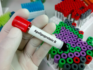 Test tube with blood sample for apolipoprotein B test