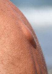 A hump on the back of a person.