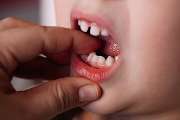 close-up the mother's hand loosens the baby tooth and shows the roots sticking out of the gum wound.