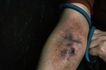 Blood hematoma close-up. Female's arm is bruised from taking intravenous narcotic. Drug addict woman pulls hand with tourniquet. Concept of despair and depression. Addiction to illegal substances.