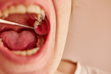 The female patient opened her mouth wide while the dentist examined the teeth with the help of a dental mirror.