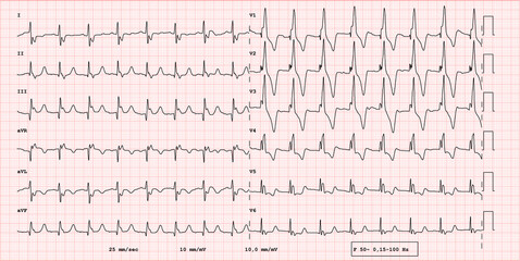 ECG example of a pathological 12-lead rhythm, Fallot's tetralogy