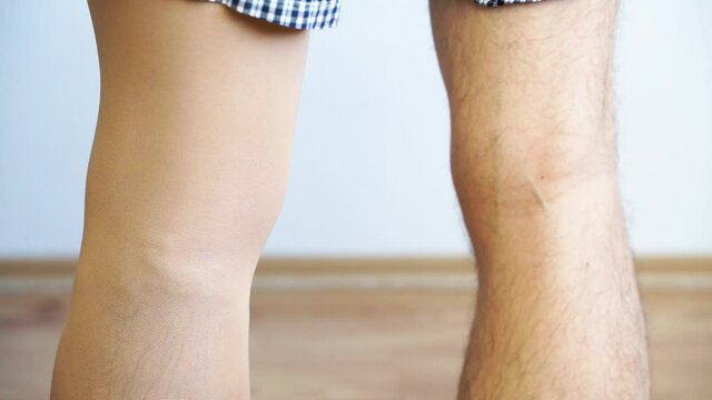 Painful varicose and spider veins on young male legs with compression stocking
