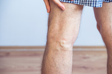 Painful varicose and spider veins on young male legs