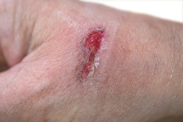 Abrasion with some fluid discharge from a woman's hand.