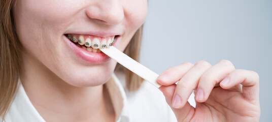 Young woman with metal braces on her teeth is chewing gum. The girl is eating gummy candy