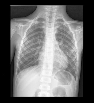 Lung woman x-ray film. Chest radiology scan. Health care patient examination. 