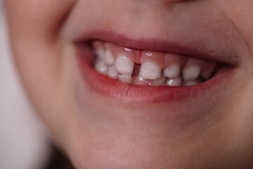 close-up mouth of a five-year-old child with baby teeth, the top row of teeth helps tilt forward loosing a temporary tooth.