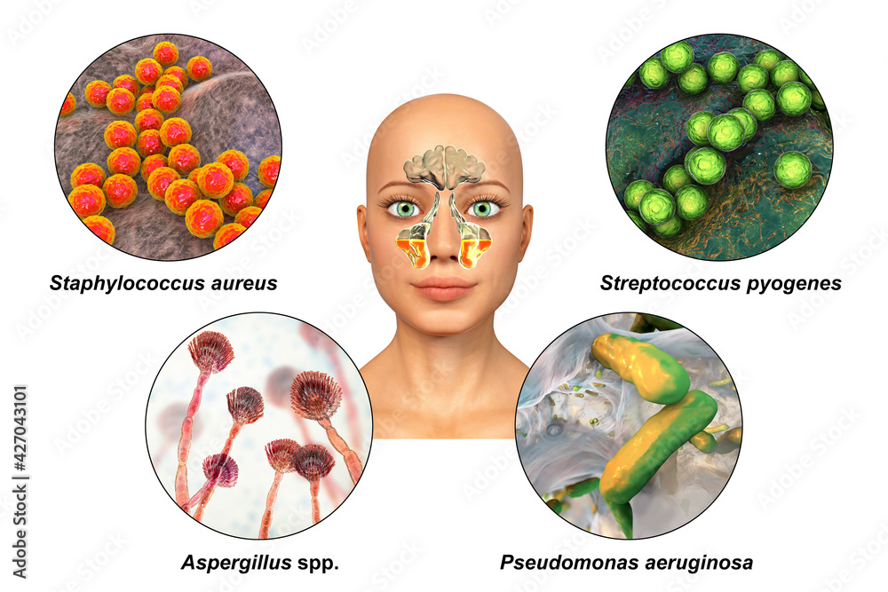 Sticker anatomy of rhinosinusitis and microorganisms that cause sinusitis