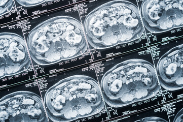 Bild einer Magnetresonaztomographie, MRT,  Computertomographie, Röntgenbild.
Bauchbereich im...