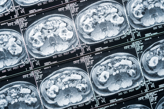 Bild einer Magnetresonaztomographie, MRT,  Computertomographie, R&ouml;ntgenbild.
Bauchbereich im Querschnitt
Bereich des Becken mit Nieren, die von Tumoren befallen sind.