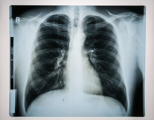 Röntgenbild einer Lunge. Oberkörper eines Mannes