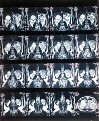 Bild einer Magnetresonaztomographie, MRT,  Computertomographie, Röntgenbild.
Bereich des Becken mit Nieren, die von Tumoren befallen sind.