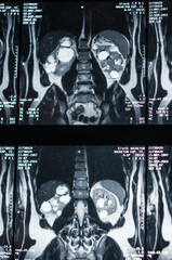 Bild einer Magnetresonaztomographie, MRT,  Computertomographie, Röntgenbild.
Bereich des Becken mit Nieren, die von Tumoren befallen sind.