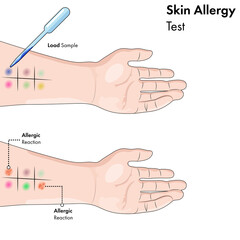 Skin allergy test in hands.