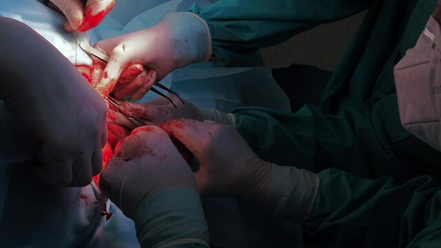 Surgeons use medical instruments to suture human skin during proctological minimally invasive surgery on the anus. Close-up of hands in sterile gloves, covered with blood. Blue uniform and masks.