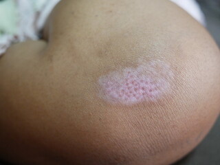 Fototapeta premium closeup of scar on female knee,healthcare concept.