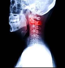 X-ray C-spine or x-ray image of Cervical spine lateral view for diagnostic intervertebral disc herniation and Spondylosis..