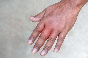 Swollen hand from insect sting, male person showing swollen fingers due to insect bites, closeup of...