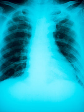 Close up human chest x-ray film, blue color.