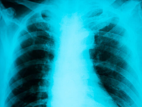Close up human chest x-ray film, blue color.