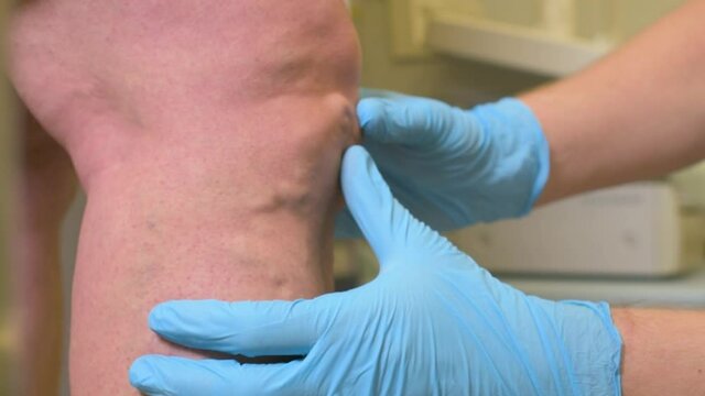 a vascular surgeon or phlebologist makes an ultrasound of varicose veins on the legs of a female patient.